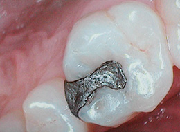 Amalgam Filling