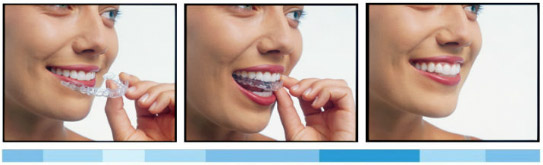 invisalign